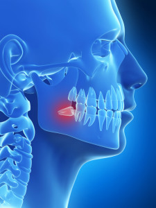 Foghúzás után - fontos tanácsok a fogorvostól - Dentpoint