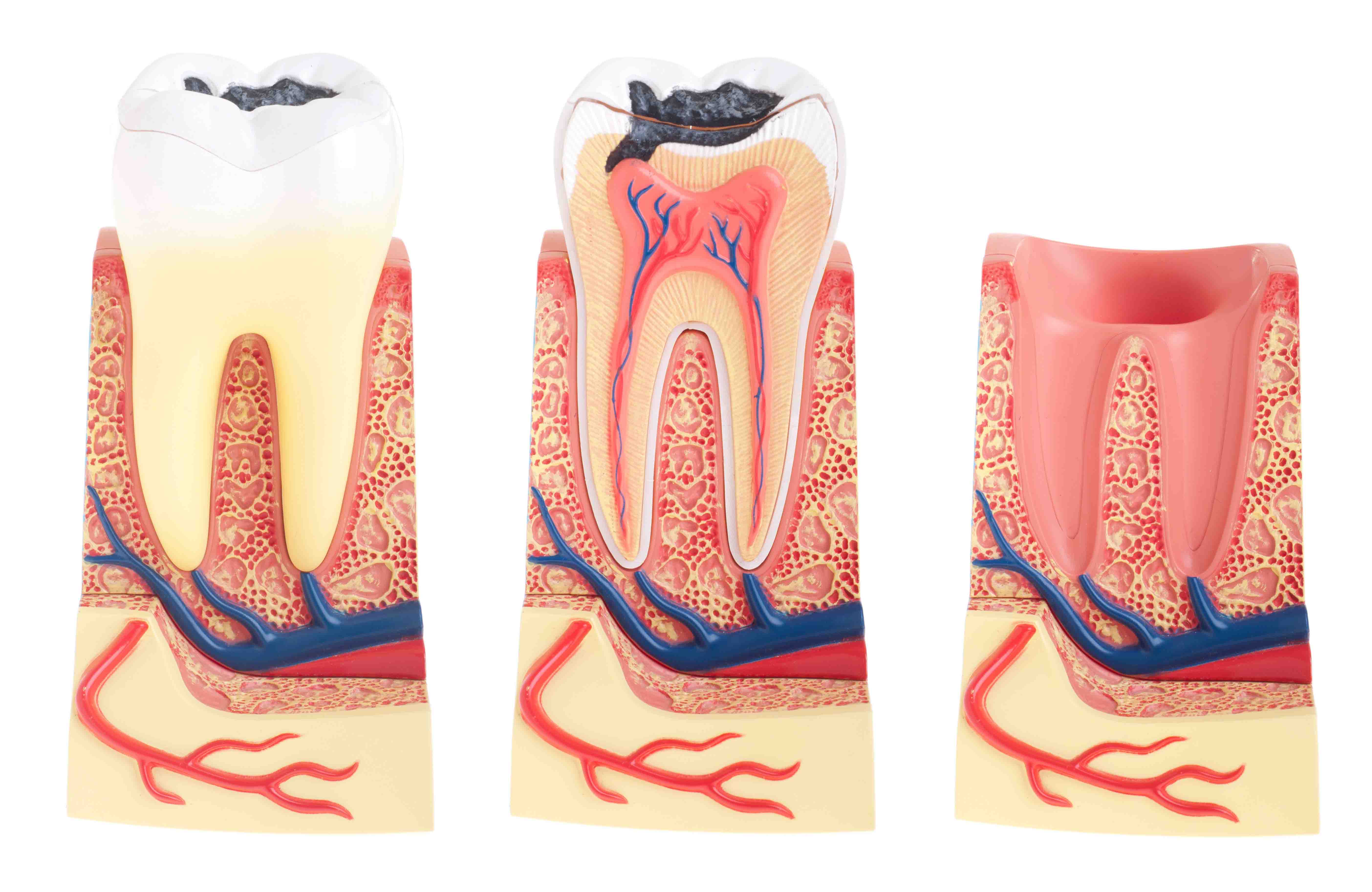 A fogszuvasodás kialakulása, tünetei és megelőzése