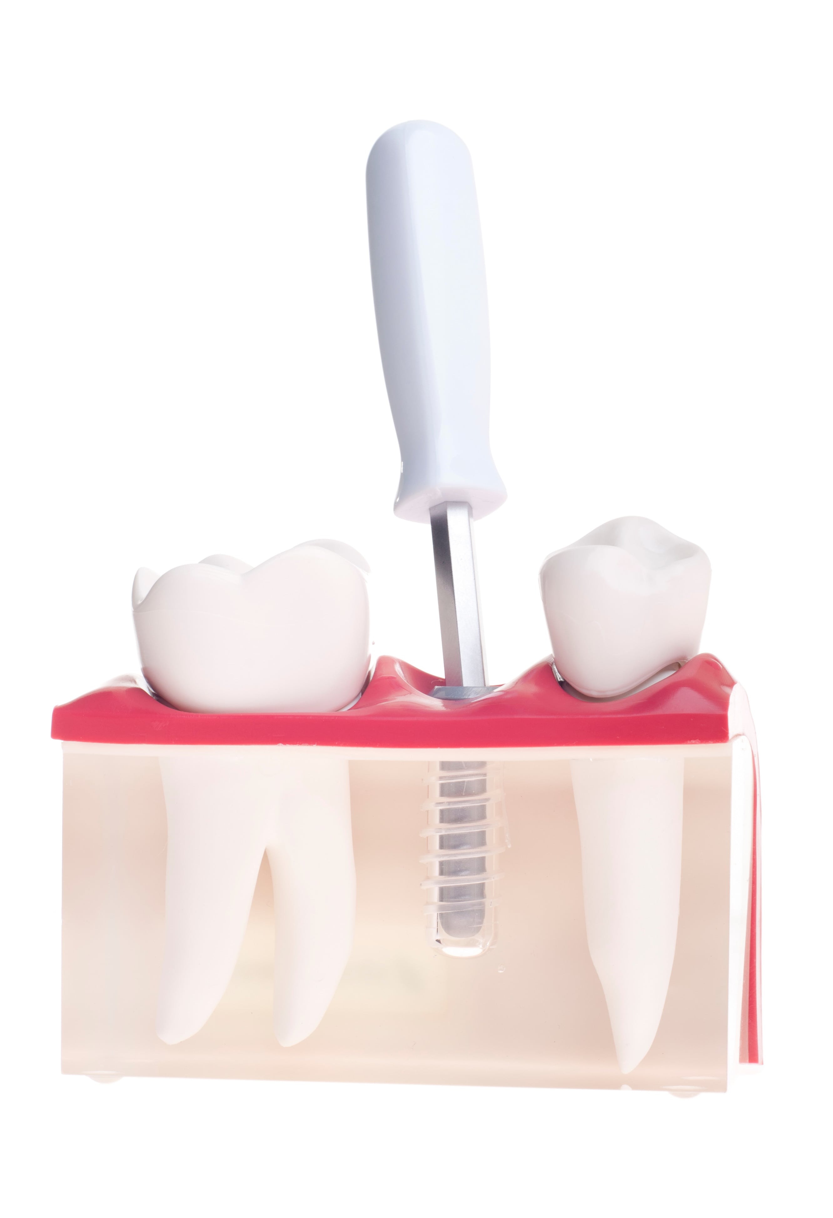 Fogbeültetés – fog implantátum árak – illusztráció