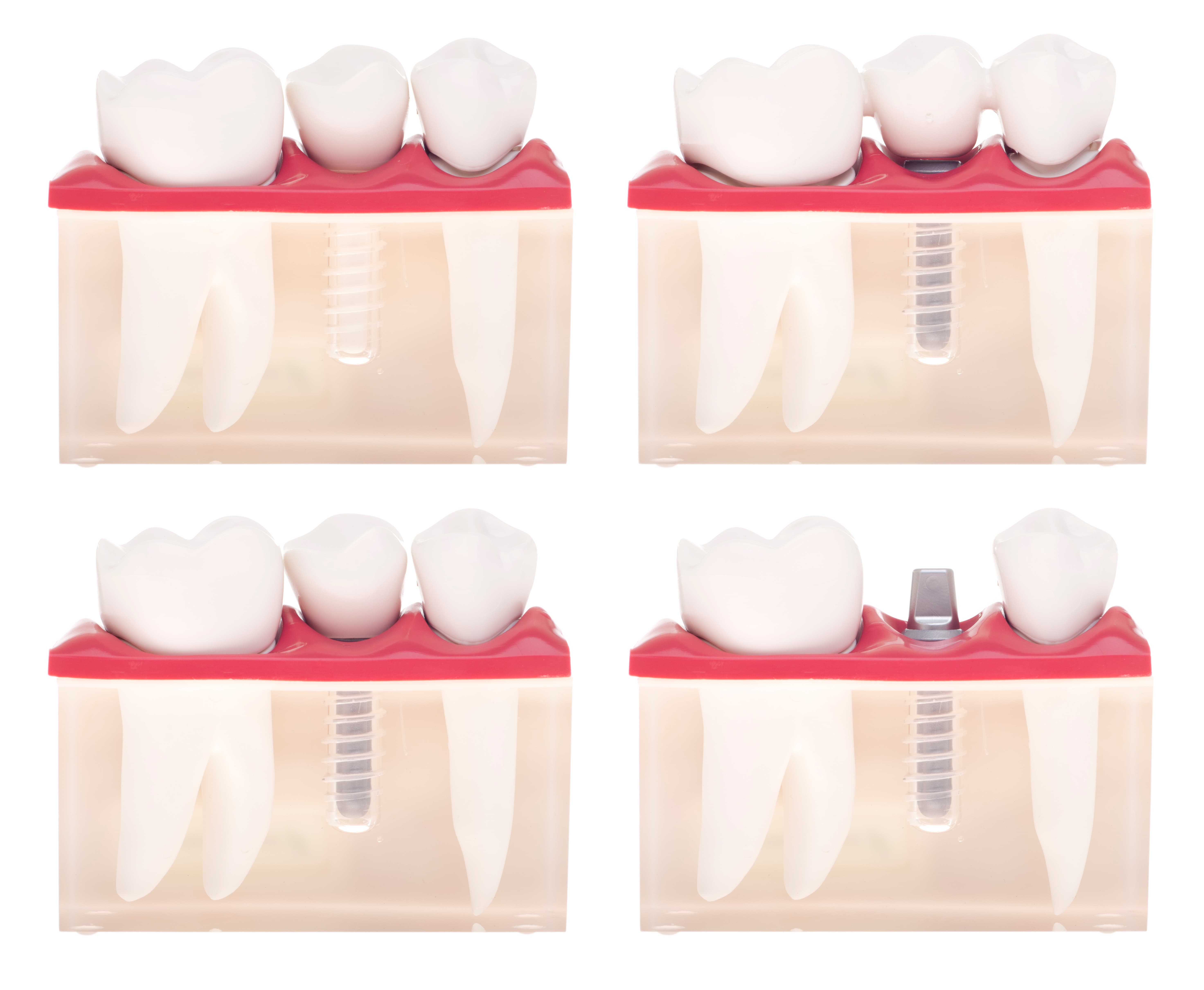 Fogbeültetés – fog implantátum árak – illusztráció