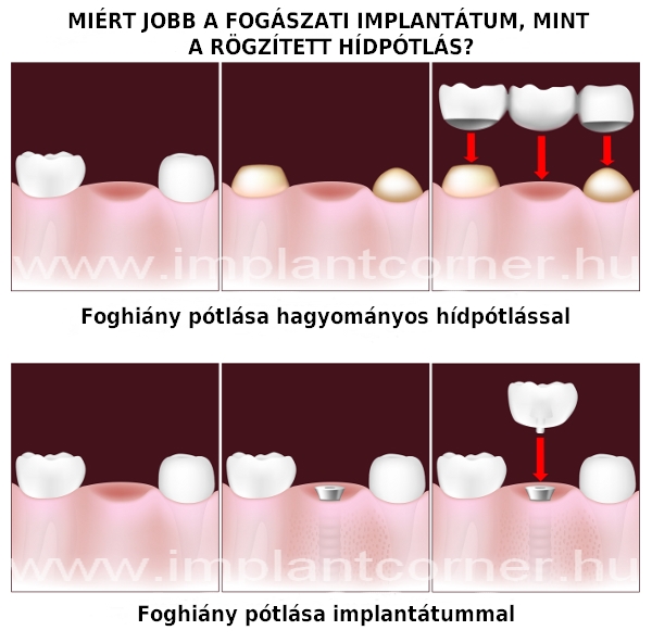 Fogimplantátum vagy híd? Melyik a jobb választás foghiány esetén?
